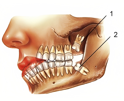 wisdom tooth extraction services in Sydney