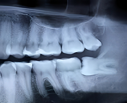 impacted wisdom teeth removal in Sydney