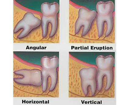 Partially erupted wisdom teeth removal procedure