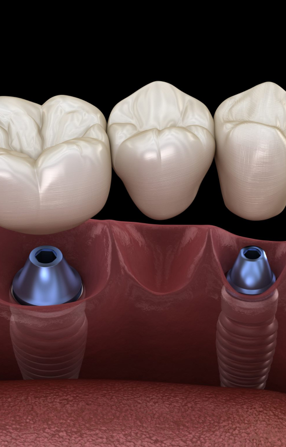Dental Implants Cost in Sydney