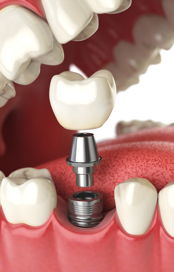 Benefits Of Sydney Dental Implants