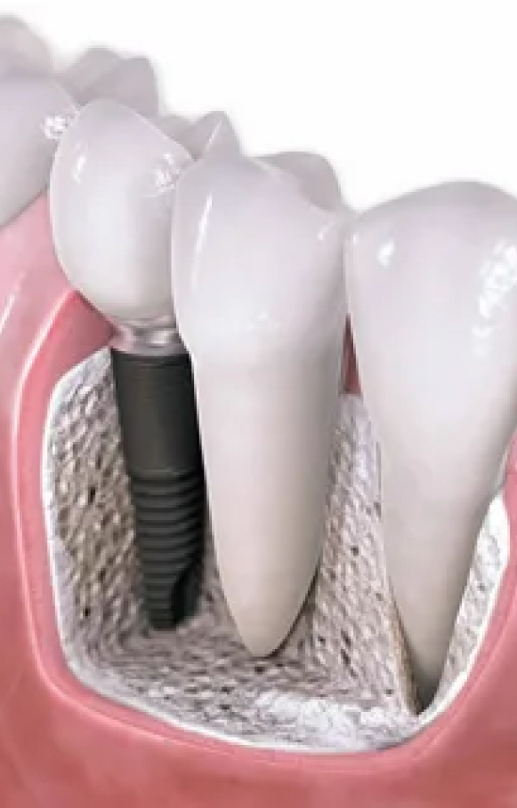 Dental Implants Are The Preferred Solution For Replacing Missing Teeth